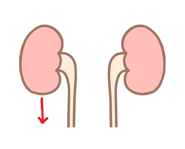 腎下垂（じんかすい）-大和クリニック-木更津市の泌尿器科